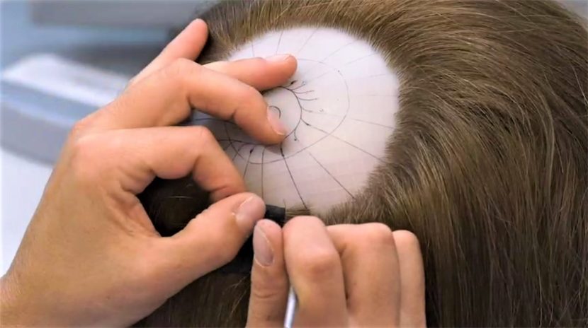 Tumori e perdita di capelli, lâinnovazione per il benessere psicologico